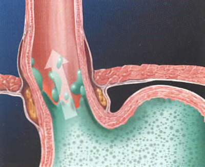 Gastroesophageal Reflux Disease 