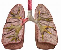 What Is Bronchitis?