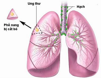 Asbestos related lung disease