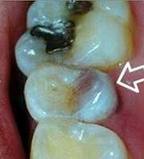 Dental cavities